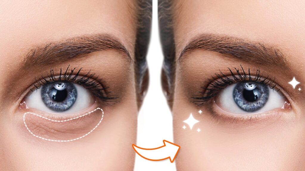 Schnelle Tipps: So beseitigen Sie dunkle Ringe unter Ihren Augen