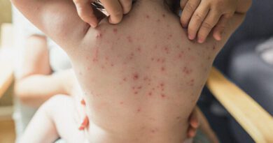 Der All-In-One-Leitfaden zur Behandlung von Windpocken bei Kindern