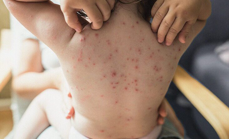 Der All-In-One-Leitfaden zur Behandlung von Windpocken bei Kindern